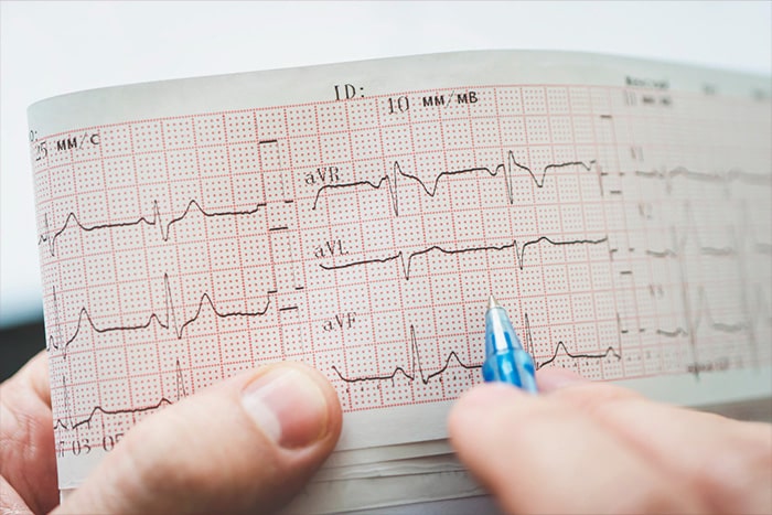 Tratamiento arritmia cardiaca Quito Cardiolo Quito 1-min